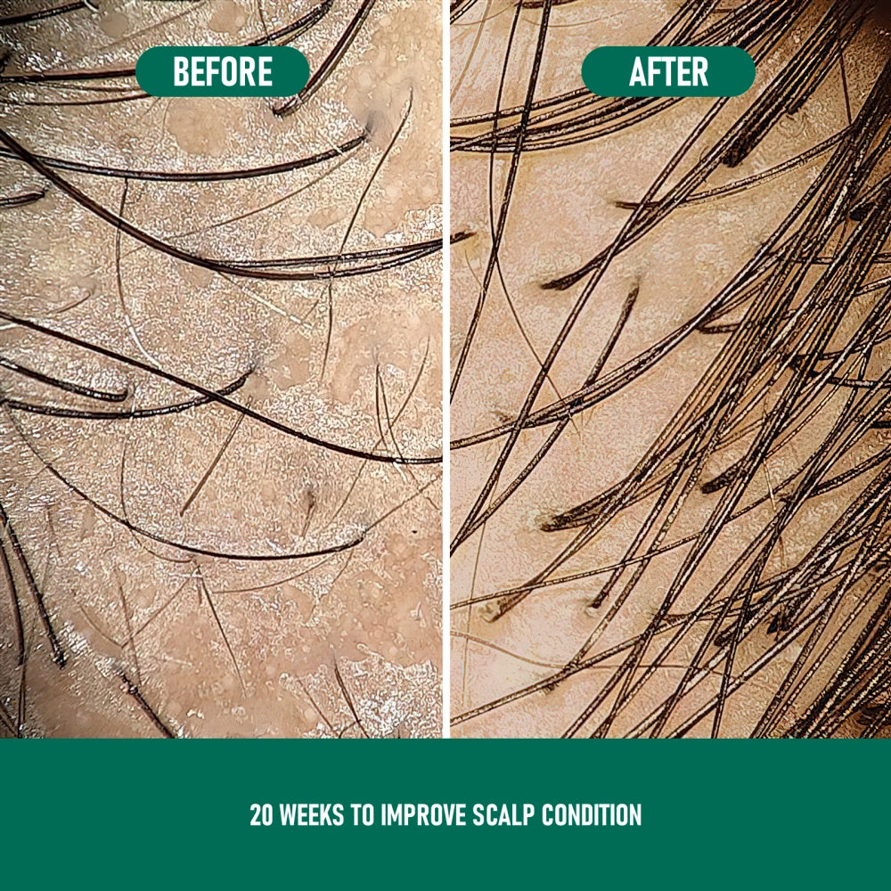 Regrowth X™ — Minoxidil Anti-Hair Loss Mousse