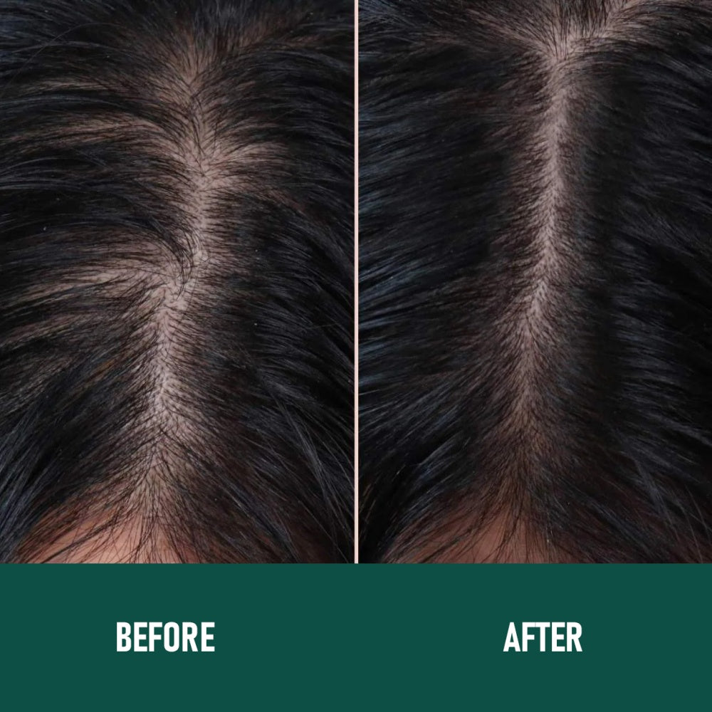 Regrowth X™ — Minoxidil Anti-Hair Loss Mousse