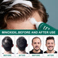 Regrowth X™ — Minoxidil Anti-Hair Loss Mousse